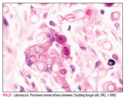 lobomycosis